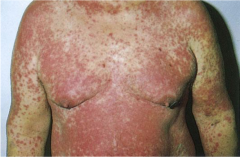 Erythematous and symmetrical rash, usually generalized.