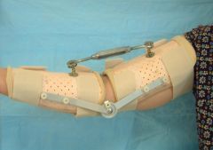 Supervised exercise therapy with static progressive elbow splinting