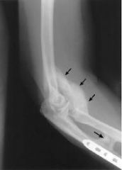 What  is the effect of   released  the the posterior oblique portion of the medial collateral ligament of the elbow?