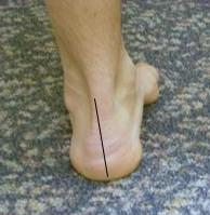 best orthotic for this correctible deformity is a semi-rigid orthotic with a recess for the head of the plantarflexed first ray and lateral hindfoot posting to correct the heel varus. This choice involves recognizing that the plantarflexed first r...