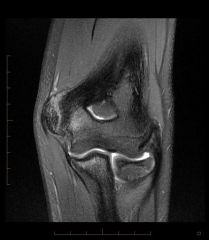 A 12-year-old baseball pitcher describes progressive worsening of medial elbow pain on his throwing side
What is the most likely cause of his symptoms? 
Moi?
-MC complication?