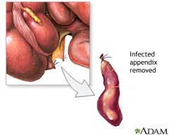 surgical removal
example: append-ectomy