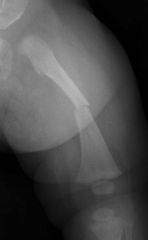 Which of the following patients would be the BEST candidate for submuscular bridge plating? 1-A 4yo B w/a spiral diaphyseal femur fx; 2-A 9yo 75-lb girl with a length stable distal one-third femur fx; 3-A 10yo, 120-lb boy w/ long spiral, comminute...