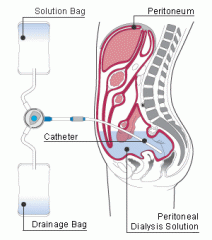 1. The peritoneum serves as a dialysis membrane. Dialysate fluid is infused into the peritoneal cavity, then fluids and solutes from the peritoneal capillaries diffuse into the dialysate fluid, which is then drained from the abdomen.
- a hyperosm...