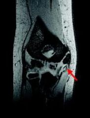 -Little Leaguer's elbow.   medial apophysitis.
-Pediatric UCL reconstruction using palmaris longus autograft
MRI- UCL insufficiency