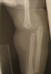 A 10-month-old child fell off of the couch and has L elbow pain & swelling. A xray Fig A. All of the following are characteristics of this injury pattern EXCEPT: 1-High risk of tardy ulnar nerve palsy; 2-Posteromedial displacement; 3-High associat...