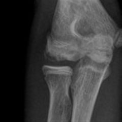 A 13-year-old pitcher develops pain over the lateral aspect of his throwing elbow. He has an effusion and a painful click on passive elbow rotation. What is the most likely diagnosis?
classification/describe?
Stx?