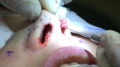 surgical repair
example: rhino-plasty (c.k.a "nose job") 