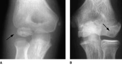 almost always occurs in the dominant elbow in boys between 5 and 12 years of age;


-dx/define?
-