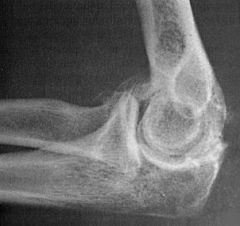 Loose bodies present in elbow joint with OCD is classified as?
mech sx?
-best test to confirm? why?