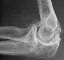 MC pt opoulation affected what is dx?
-who is affected?
-stx if  incompetent elbow ligaments