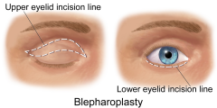 eyelid
example: blephar-oplasty