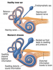 Results from ↑ amount of endolymph that enlarges the membranous
labyrinth.

Symptoms: hearing loss + tinnitus + vertigo

Almost total destruction of hearing may occur over a
period of years.
