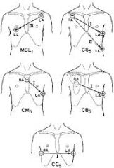 A
The central subclavicular (CS5) lead is particularly well suited for the detection of anterior myocardial wall ischemia. The right arm (RA) electrode is placed under the right clavicle, the left arm (LA) electrode is placed in the V5 position, ...