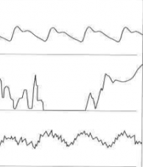 Øverste linje viser grafen fra en normal pulsoksymetri. Hva viser linje 2 og 3?