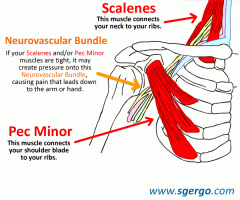The thoracic outlet space is created by the clavicle, first rib, subclavius muscle, costoclavicular ligament, and anterior scalene muscle. It most often affects subclavian artery, vein, and the lower trunk (C8 & T1) of the brachial plexus. The neu...