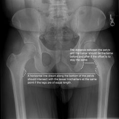 Restoration of limb length is essential following total hip arthroplasty. The amount of limb-length change will be the vertical distance between the center of rotation of the femoral component and the center of rotation of the acetabular component...