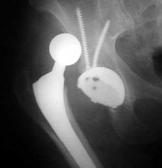 Which of the following factors is most likely to increase the risk of hip dislocation after a total hip arthroplasty (THA)? 
1.  Large head-to-neck ratio 
2.  Use of a skirted femoral head 
3.  Femoral component in 15 degrees of anteversion 
4...