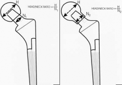 The use of a skirted femoral head actually decreases the head to neck ratio as seen in illustration A, and leads to increased risk of hip impingement and dislocation after THAs. Illustration B shows an example of a smaller head-to-neck ratio causi...