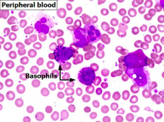 - ↑↑↑ Leukocytosis (>100,000 / µL)
- Neutrophilia (>7000 / µL)
- Immature myeloid cells, rare myeloblasts (2-3%)
* Basophilia
- Thrombocytosis (50% of cases)