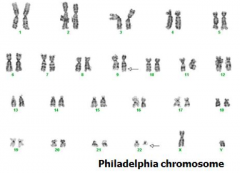 - Type of Myeloproliferative Neoplasms (MPNs)
* BCR-ABL fusion gene → produces a protein w/ Tyrosine Kinase activity
* t(9;22) → Philadelphia Chromosome → BCR-ABL fusion gene