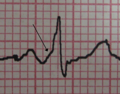 - Verbindung des Vorhofs mit dem rechten (Typ 1) oder linken (Typ 2) Ventrikel über das Kent-Bündel.


- δ Welle im EKG (träger R Anstieg)