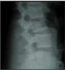 The radiographs and CT scan show a burst fracture with minimal resultant kyphosis and minimal canal compromise. Because the patient is neurologically intact, and there is no evidence of injury to the posterior ligament complex (no increase in inte...