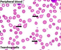 - Typical / fibrotic stage
- Peripheral blood w/ normochromic, normocytic anemia
- Frequent teardrop cells
- Leukoerythroblastic reaction
