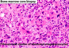 - Fibrosis
- Clusters of atypical megakaryocytes
- Generally increased platelet count, may be variable