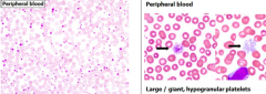 - Elevated platelet count >450,000/µL
- Platelets have atypical morphology (large/giant, hypogranular)
- Mild neutrophilic leukocytosis
