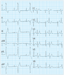 - häufig asymptomatisch (Bei Salven Synkopen, Schwindel)


- EKG: verbreiterte QRS ohne vorausgehende P welle


(Aus Form der QRS kann auf Entstehungsort der VES geschlossen werden. zb Bild: linksschenkelblock→re Ventrikel)  