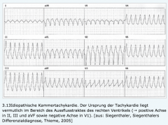 - Palpitation, Herzrse, AP und Dyspnoe


- EKG: breite QRS die Schenkelblockartig (biphasisch) deformiert sind


→ QRS > 0.16s bei scheinbarem LSB


→ QRS >0.14s bei scheinbarem RSB


- AV-Dissozation (mehr QRS als P)