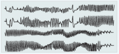 - Anfallsartiges Auftreten mit Schwindel und Synkope


- EKG: Spindelform, zu Beginn Qt > 550ms, abnorme T und U Wellen