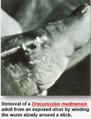 Diagnose by finding worm at site of ulcer. Treatment is removing the worm. 