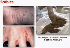 Sarcoptes scabiei is transmitted via infected people or fomites. Adults burrow in skin and lay eggs which causes intense itching, secondary excoriation and bacterial superinfection. Norwegian scabies can occur in immunosupressed patients resulting...
