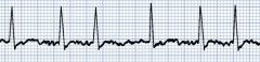 What is this ECG showing?