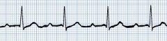 What is this an ECG of?