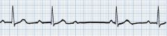 What is this an ECG of?