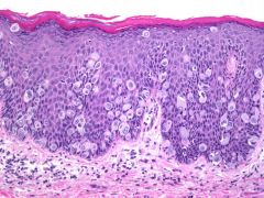 Vulvar lesion showed the following IHC profile: CK7+, CK20-, CEA+, GCDFP-15+, HMB-45-, Uroplakcin III-, 
Most likely dx?