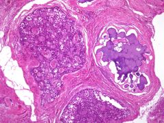 What is this lesion in the ovary?
What other tumor may develop?
What chromosome do patients carry?