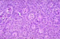 Call-Exner bodies
granulosa cell tumor
75% associated w/ hyperestrinism which may cause endometrial hyperplasia.