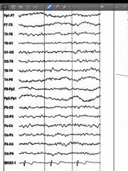 In the EEG, the state of the patient is most likely

A. Awake
B. drowsy
C. REM sleep
D. Stage N2  sleep