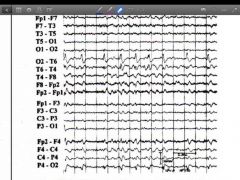 Which of the patterns is present in the sample? 

A. Periodic lateralized Epileptiform discharges
B. occipital rhythmic delta activity
C. Positive occipital sharp transients of sleep
D. Frontal intermittent rhythmic delta activity