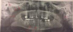 #6
ring-shaped radiopacity surrounding lingual foramen; tiny bumps of bone on lingual aspect