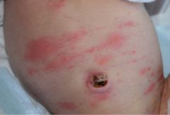 50% of infants

aka body acne or body rash

clears within 2 weeks and up to 4 months
