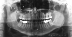 #3 radiolucent area above the mental ridge; scooped-out depressed area located on mandible
*mental ridge: radiopaque prominence from premolar to incisor