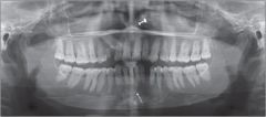 
small radiolucent dot inferior to the apices of the mandibular incisors; tiny opening or hole on internal surface of mandible near midline