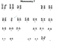 - Monosomy 5 or del5q
- Trisomy 8
- Monosomy 7 or del7q

- 50% of cases