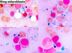 - Red cell precursors w/ frequent iron granules surrounding the nucleus
- Abnormal iron accumulation in functionally impaired mitochondria

- Associated with Myelodysplastic Syndromes (MDS) and other non-neoplastic conditions like alcohol consu...