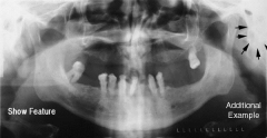 large, rounded radiopacity posterior and inferior to the TMJ; prominence part of temporal bone
